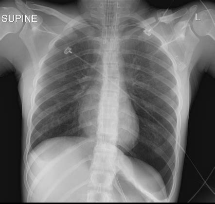 Double Diaphragm Sign Radiology Reference Article Radiopaedia Org