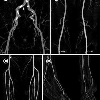 Central pulmonary vessels are larger than normal, especially when compared to peripheral pulmonary vessels. (PDF) CT Angiography of Peripheral Arterial Occlusive Disease