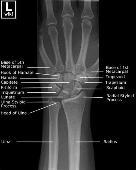 Frontal Radiograph Of The Wrist With Labels Wrist Anatomy Radiology