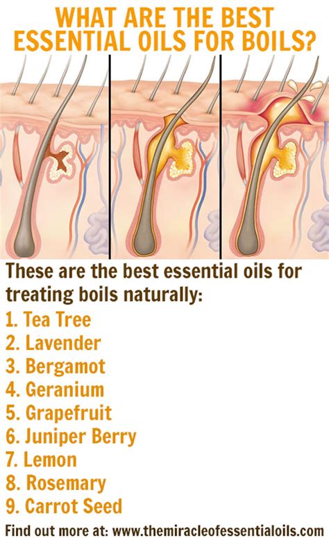 9 Best Essential Oils For Boils And Diy Recipes The Miracle Of