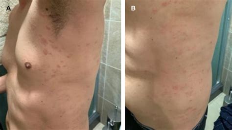 Pityriasis Rosea And Covid 19