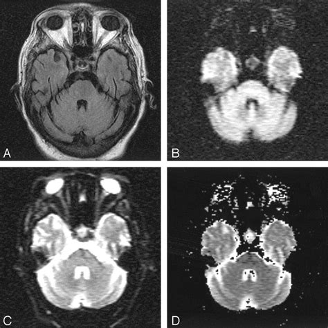 Early Diagnosis Of Central Pontine Myelinolysis With Diffusion Weighted