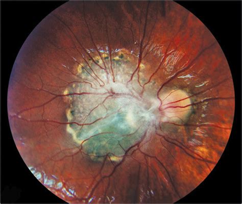 Combined Hamartoma Of The Retina And Retinal Pigment Epithelium