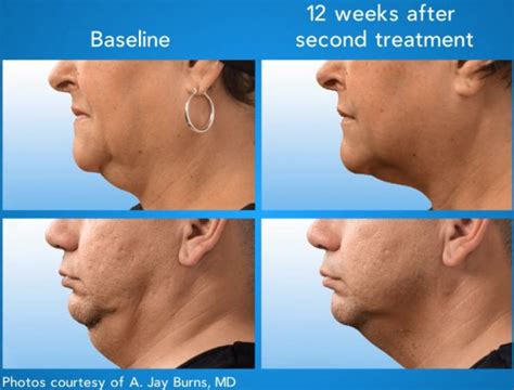 Coolsculpting Double Chin Lax 1 Laser Spa Group