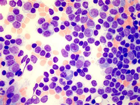 Pathology Outlines Lymphoplasmacytic Lymphoma