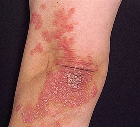 Psoriasis Appearance Causes Types Symptoms Treatment And Diet