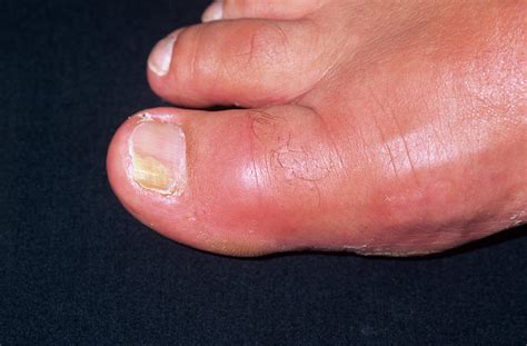 Cellulitis Photograph By Dr P Marazziscience Photo Library