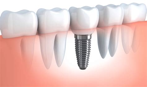 Cost Of Dental Implants Dentistry Cornwall Dentist Cornwall