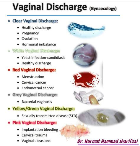 Vaginal Discharge Gynecology Medizzy
