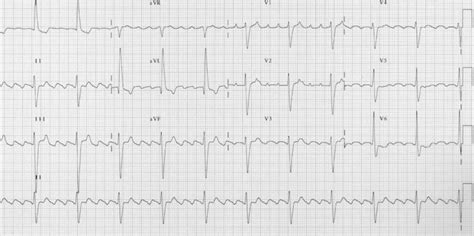 Atrial Flutter Litfl Ecg Library Diagnosis 45486 Hot Sex Picture