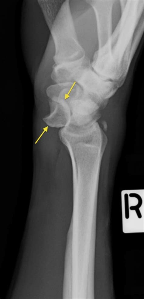 Scaphoid Bone Anatomy Lateral Radiograph