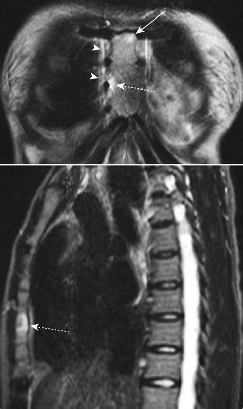 Mri Inflammation Of The Anterior Chest Wall In An As Patient Without