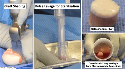 Osteochondral Allograft Transplantation An Alternative To Knee Joint