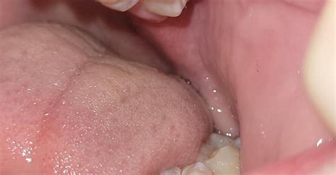 sideways second molar album on imgur