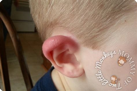 Red Swollen Ear Lobe What Happened To His Ear Mommity