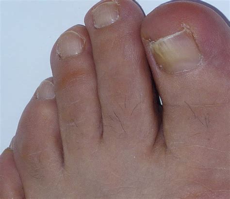 Search Results Wikiskin Cancer Under Toenail Hairstyle Galleries