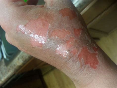 2nd Degree Burns Healing Stages Pictures Causes Treatment