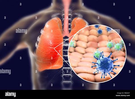 Viral Pneumonia Conceptual Illustration Human Lungs And Close Up View