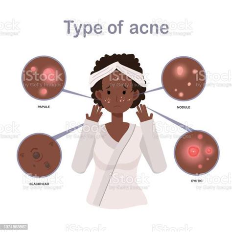 여드름 유형얼굴에 여드름을 가진 아프리카 계 미국인 여성 얼굴 아름다움 화장품 메이크업 치료 건강 플랫 벡터 만화 캐릭터