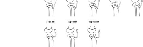 Avulsion fracture of the tibial tuberosity is an infrequent injury in adolescents and an extremely rare occurrence in adults. Classification of tibial tubercle avulsion fractures [3 ...