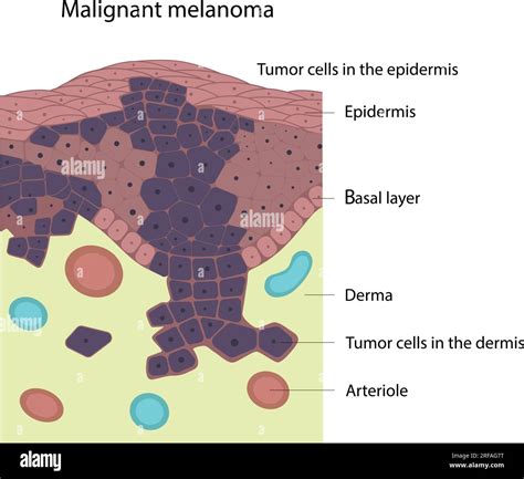 Malignant Melanoma Skin Disease Skin Cancer Stock Vector Image And Art