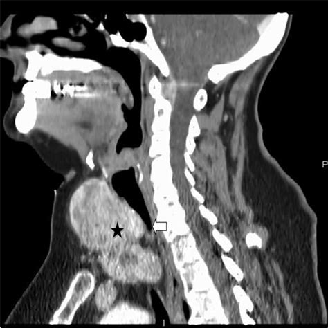 Dyspnea In Multinodular Goiter A Case Report Of Substernal