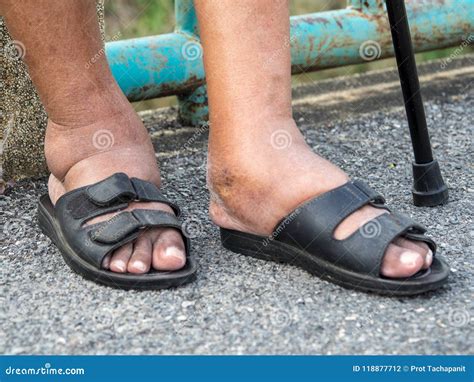 The Feet Of Man With Diabetes Dull And Swollen Due To The Toxicity Of