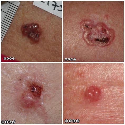 Basal Cell Carcinoma Skin Cancer 909