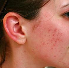 Walaupun jerawat umumnya terjadi pada remaja, siapa pun dari bayi hingga lansia bisa mengalaminya. Cara Menghilangkan Jerawat Secara Alami Dan Mudah ...