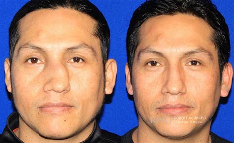 Facial Fracture Repair Nyc Facial Injuries New Jersey