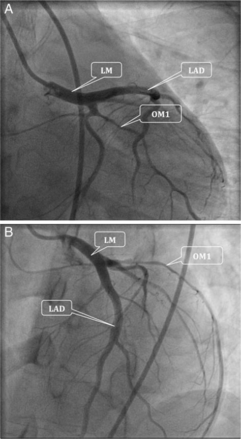 Coronary Angiograms Showing The Obtuse Marginal Branch With Good Distal