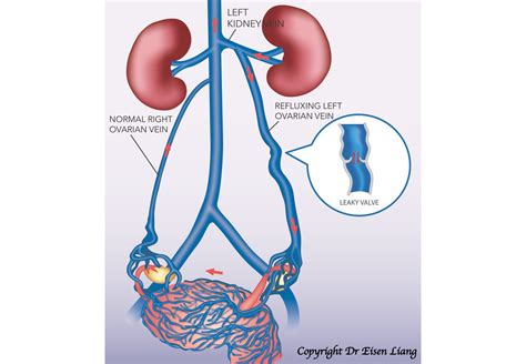 Pelvic Congestion Faqs Sydney Fibroid Clinic