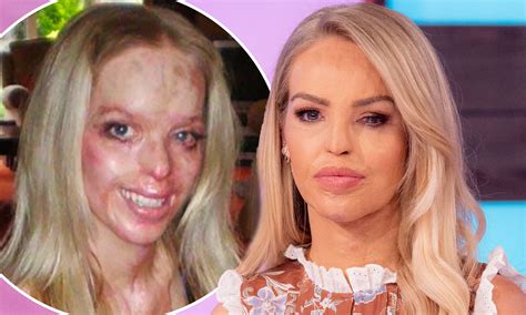 Katie Piper Before And After