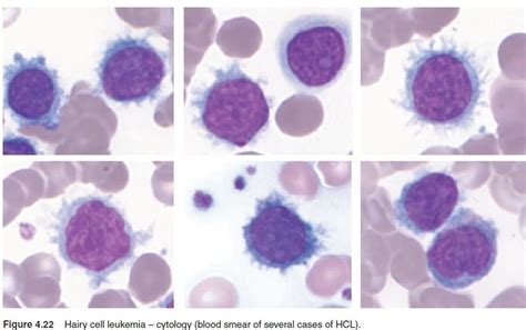 Veterinary Hematology Dextervet Hairy Cell Leukemia