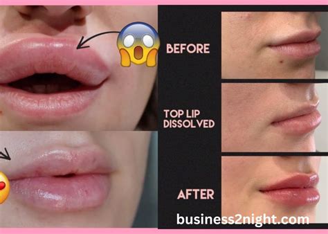 Lip Filler Swelling Stages Understanding The Proces