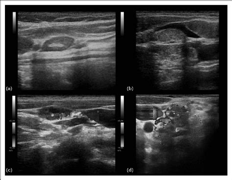 Neck Ultrasound A Nonmetastatic Neck Lymph Node Oval Elongated