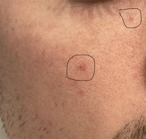 Skin Concern Red Marks On Face That Wont Go Away Please Help R