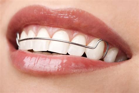 Teeth Retainers After Braces Usage Benefits And Care Tips