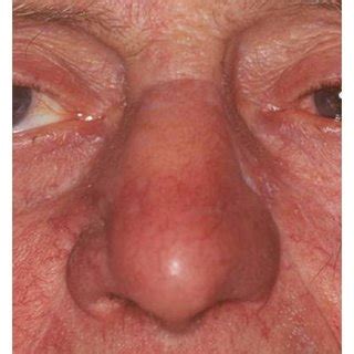 Pdf Reconstruction Of Nasal Skin Cancer Defects With Local Flaps