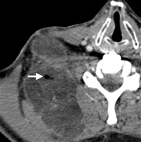 Soft Tissue Tumors Of The Head And Neck Imaging Based Review Of The