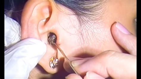 Impacted Rock Hard Earwax Removal Youtube