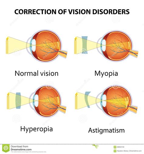 Hyperopia And Myopia Human Eye Disease Infographic Diagram Medical