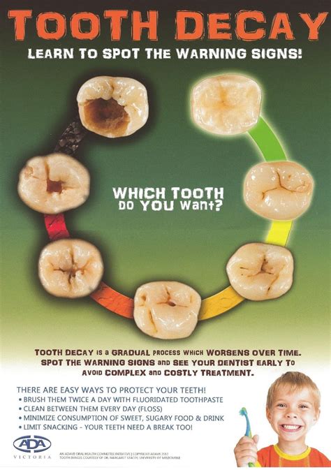 Tooth Decay Learn To Spot The Warning Signs Escuela De Higiene