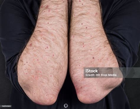 Foto De Sarampo Doença Viral De Dermatite De Imunodeficiência Erupção Cutânea No Corpo De Um