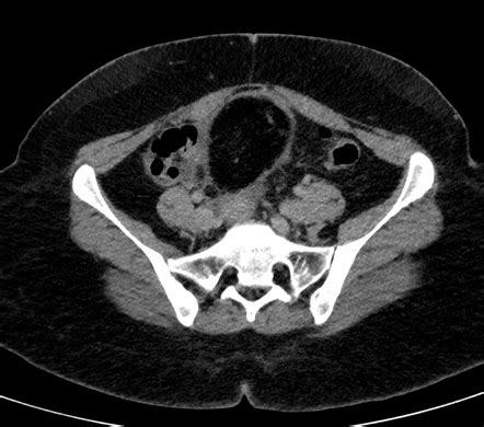 Mature Ovarian Teratoma With Tubo Ovarian Torsion Radiology Case