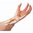 Tendonitis In The Wrist  Panther Sports Medicine