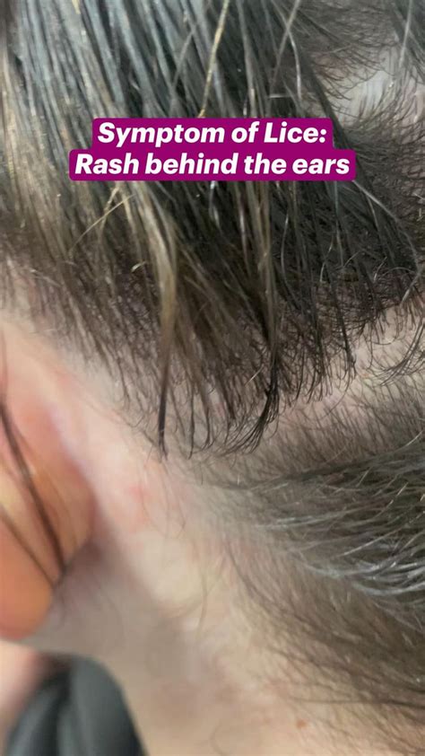 Symptom Of Lice Rash Behind The Ears In 2022 Symptoms Rashes Louse