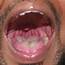 On Arrival Swelling Of The Uvula And Surrounding Tissues Almost 