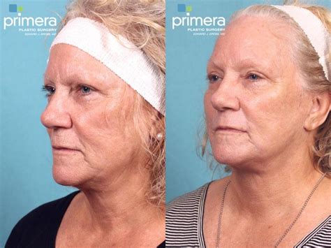 Chemical Peel Before And After Pictures Case 521 Orlando Florida