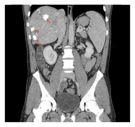 Case 2 Histologic Features Of The Sigmoid Colon Mass Lymph Node And